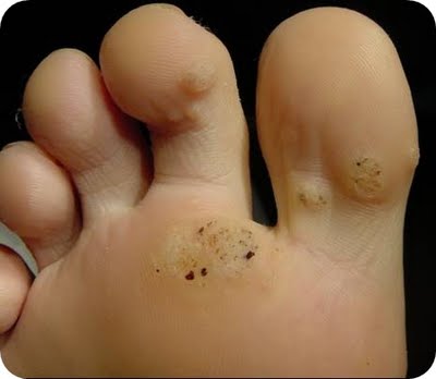 Verruga_plantar.jpg