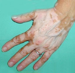 vitiligo.jpg